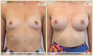 Breast Augmentation 40 - 39