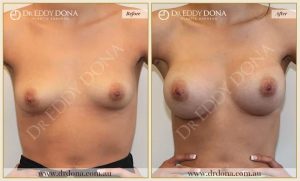 Breast Augmentation 34 - 33