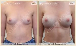 Breast Augmentation 23 - 22