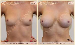 Breast Augmentation 49 - 48