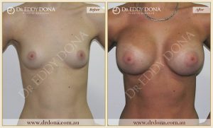 Breast Augmentation 24 - 23
