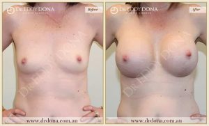 Breast Augmentation 25 - 24
