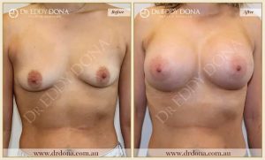 Breast Augmentation 43 - 42