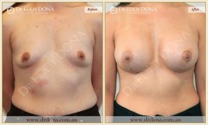 Breast Augmentation 44 - 43
