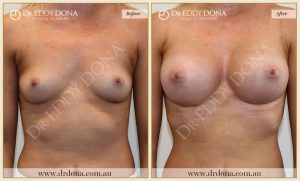 Breast Augmentation 42 - 41