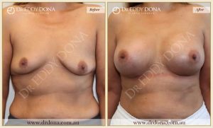 Breast Augmentation 48 - 47