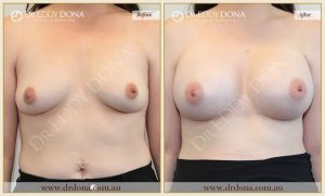 Breast Augmentation 46 - 45