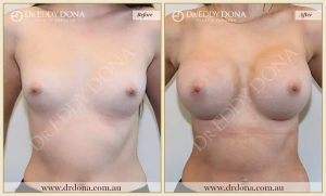 Breast Augmentation 29 - 28