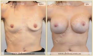 Breast Augmentation 28 - 27