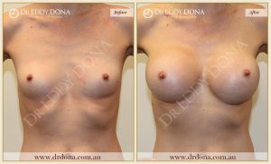 Breast Augmentation 27 - 26