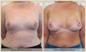 Breast Augmentation 30 - 29