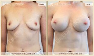Breast Augmentation 45 - 44