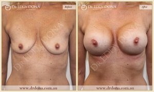 Breast Augmentation 41 - 40