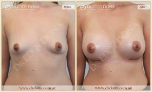 Breast Augmentation 47 - 46