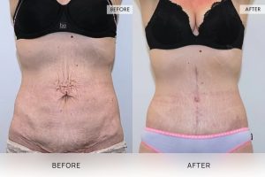 Fleur De Lis Tummy Tuck Patient 01 - 2