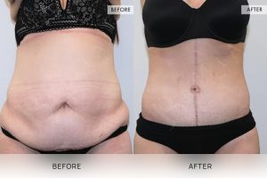 Fleur De Lis Tummy Tuck Patient 02 - 3