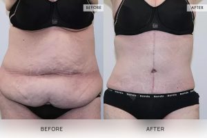 Fleur De Lis Tummy Tuck Patient 03 - 4