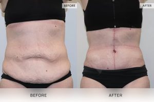 Fleur De Lis Tummy Tuck Patient 04 - 5