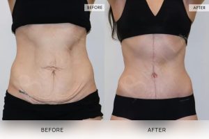 Fleur De Lis Tummy Tuck Patient 05 - 6