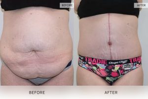 Fleur De Lis Tummy Tuck Patient 06 - 7