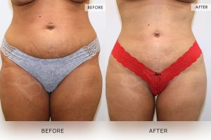Liposuction Patient 01 - 2