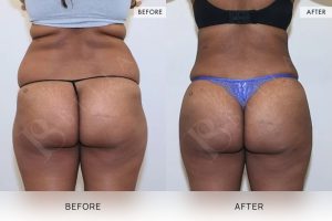Liposuction Patient 02 - 3