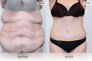 Open Book Tummy Tuck Patient 01 - 2