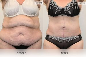 Open Book Tummy Tuck Patient 10 - 11