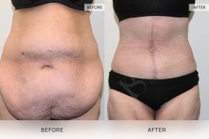 Open Book Tummy Tuck Patient 11 - 12