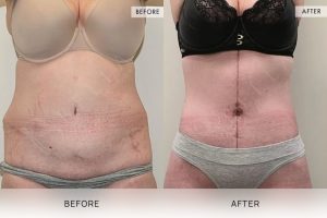 Open Book Tummy Tuck Patient 12 - 13