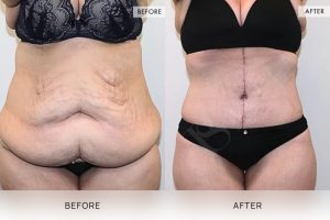 Open Book Tummy Tuck Patient 13 - 14