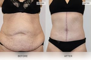 Open Book Tummy Tuck Patient 14 - 15