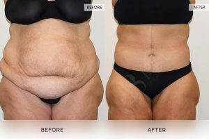 Open Book Tummy Tuck Patient 15 - 16