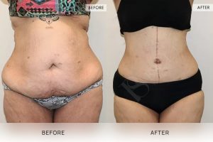 Open Book Tummy Tuck Patient 16 - 17