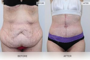 Open Book Tummy Tuck Patient 17 - 18