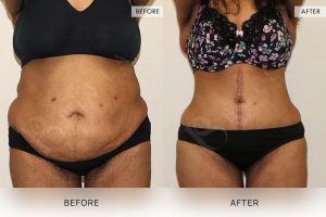 Open Book Tummy Tuck Patient 18 - 19