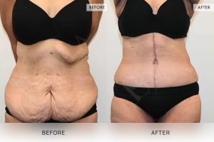 Open Book Tummy Tuck Patient 19 - 20