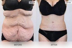 Open Book Tummy Tuck Patient 02 - 3