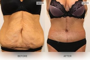 Open Book Tummy Tuck Patient 20 - 21