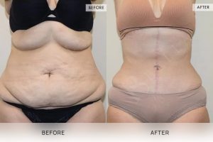 Open Book Tummy Tuck Patient 21 - 22