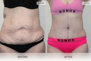 Open Book Tummy Tuck Patient 22 - 23