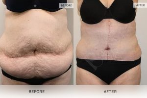 Open Book Tummy Tuck Patient 23 - 24