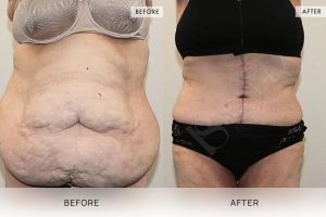 Open Book Tummy Tuck Patient 24 - 25