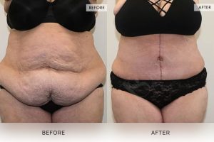 Open Book Tummy Tuck Patient 25 - 26
