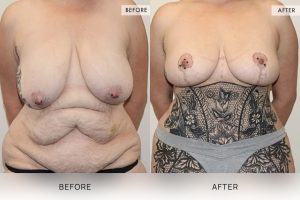 Open Book Tummy Tuck Patient 26 - 27