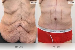 Open Book Tummy Tuck Patient 27 - 28