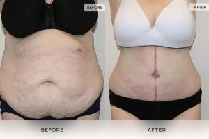 Open Book Tummy Tuck Patient 28 - 29