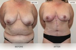 Open Book Tummy Tuck Patient 29 - 30