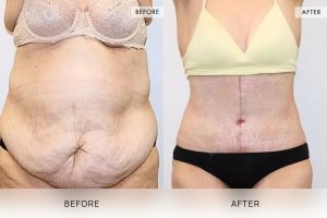 Open Book Tummy Tuck Patient 03 - 4