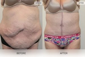Open Book Tummy Tuck Patient 30 - 31